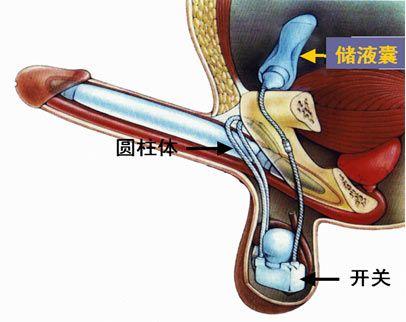 勃起21厘米粗6厘米怎么办(处理勃起21厘米粗6厘米的方法, 建议)